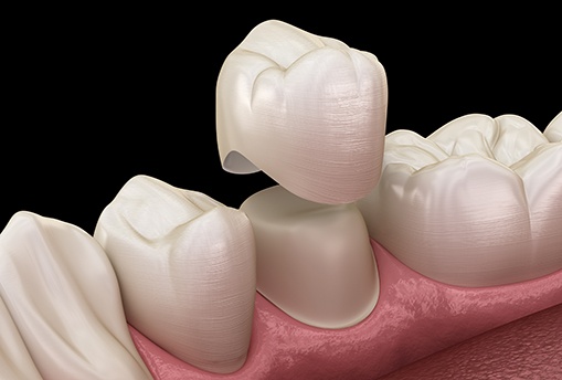 Illustration of dental crown being placed on prepared tooth