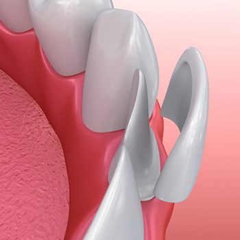 a patient undergoing the veneer process